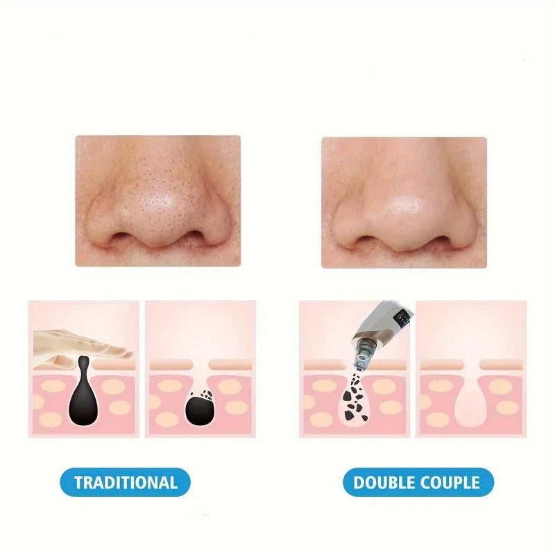 Blackhead Remover - Multipurpose